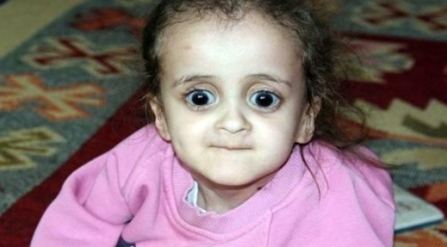 100 binde bir kişide görülüyor!