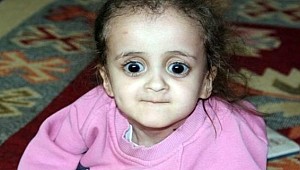 100 binde bir kişide görülüyor!