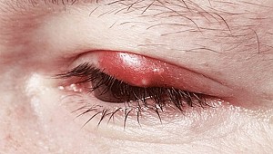 Göz iltihaplanmalarına dikkat!