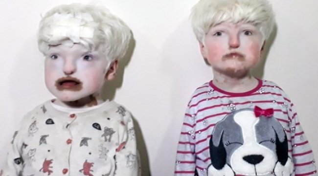 Mardinli albino kardeşler yardım bekliyor