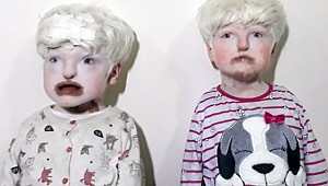 Mardinli albino kardeşler yardım bekliyor