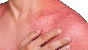 Ne diş macunu ne yoğurt, yanıkta en etkili tedavi su