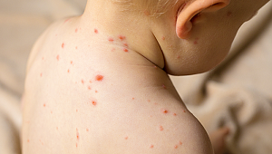 Dünya Sağlık Örgütü'nden kızamık uyarısı