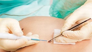 Yeni çıkan benler neyin işaretçisi?