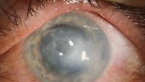 Kontakt lens kullananlara 'körlüğe yol açan enfeksiyon' uyarısı