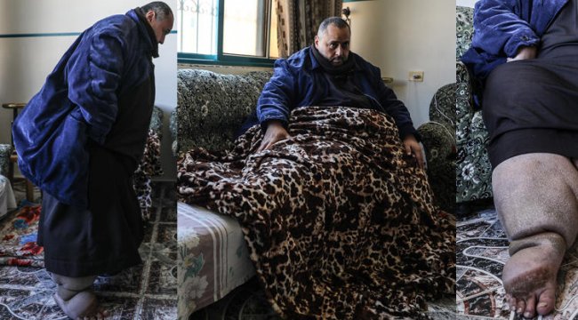 Fil hastalığına yakalanan Filistinli tedavi olacağı günü bekliyor