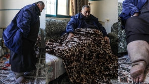 Fil hastalığına yakalanan Filistinli tedavi olacağı günü bekliyor