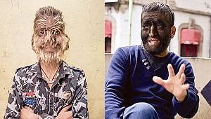 Kusurlu ilaç kurt adam yaptı