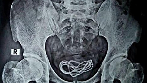 Hindistan’da bir kişinin mesanesinden bir metre uzunluğunda şarj kablosu çıktı