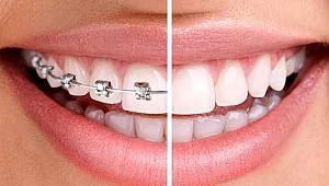 Tel takmadan düzgün dişlere sahip olmak mümkün 