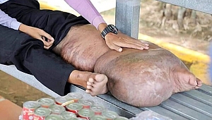 Kamboçya'da sivrisineğin ısırdığı adamın ayağı bu hale geldi