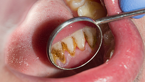 8 büyük hata! Dişler bu yüzden çürüyor diş fırçası bile çıkaramıyor