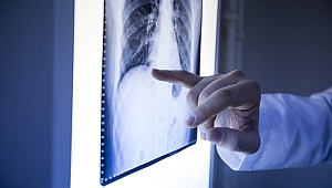 Akciğer kanseri uyarısı! 'Koronavirüs sayesinde ortaya çıkıyor'