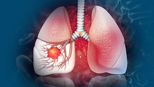 İleri evre akciğer kanserinde umut veren tedavi