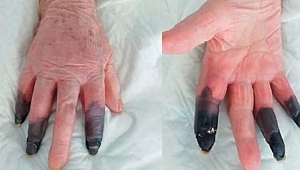 Kovid-19'a yakalandı, kangren olan parmaklarını kaybetti!