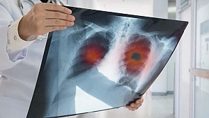 Covid-19 için çekilen tomografiler akciğer kanserlerini erken evrede yakaladı