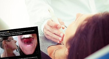 Bademcik iltihabı sandı kanser çıktı! Yüzü ve boynunda yanıklar oluştu, konuşmakta bile zorlanıyor...