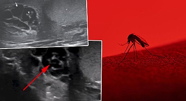 Her şey bir sivrisinek ısırığı ile başladı... Korkunç gerçeği ultrason çektirince öğrendi: Düzinelerce solucan vücudunda haftalarca yaşadı