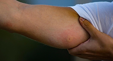 Böcek ısırığı nedeni ile doktora gitti hayatının şokunu yaşadı: 'Dünyamız yıkıldı, kimsenin başına gelsin istemem'