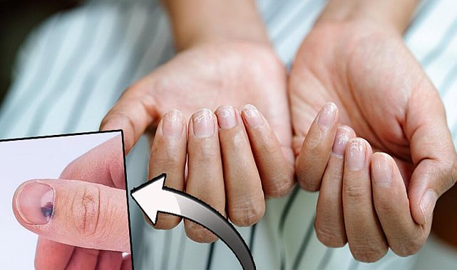 Tırnaklarınız sağlığınız hakkında neler söylüyor? İşaretler tek tek açıklandı...Lekelere dikkat: Kanserin habercisi mi?