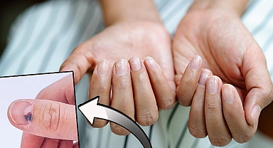 Tırnaklarınız sağlığınız hakkında neler söylüyor? İşaretler tek tek açıklandı...Lekelere dikkat: Kanserin habercisi mi?