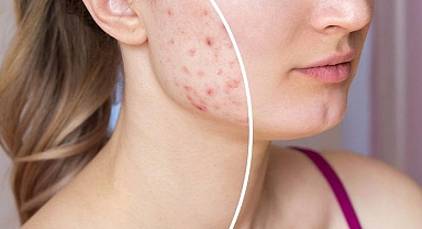 İltihaplı sivilce nasıl geçer, patlatmak zararlı mı? Beyaz iltihaplı sivilce neden olur, doğal yöntemlerle nasıl geçer?