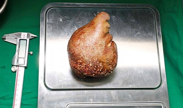Neredeyse 1 kilogram! Doktorlar bile inanamadı, dünya rekoru olarak tarihe geçti...