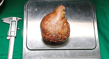 Neredeyse 1 kilogram! Doktorlar bile inanamadı, dünya rekoru olarak tarihe geçti...