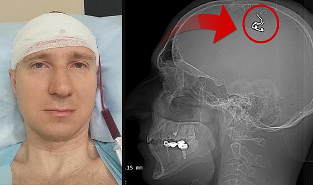Rüyalarını kontrol etmek için kafasını matkapla deldi! 'Yaşadığım için mutluyum ama ölmeye hazırdım'
