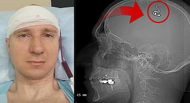 Rüyalarını kontrol etmek için kafasını matkapla deldi! 'Yaşadığım için mutluyum ama ölmeye hazırdım'