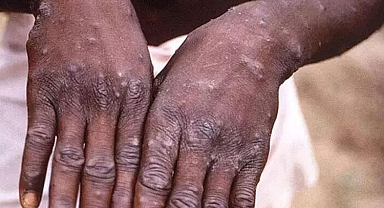 Güney Afrika'da maymun çiçeği virüsünden iki günde ikinci ölüm