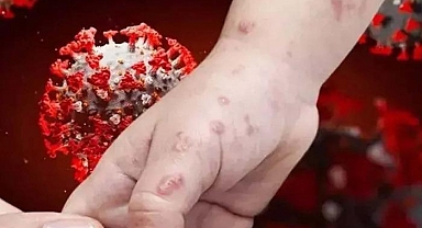 DSÖ'den Maymun çiçeği virüsü için harekete geçti