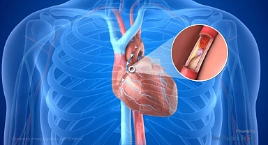 Koroner Bypass veya Stent Sonrası Motoru Sıfırladık Zannetmeyin
