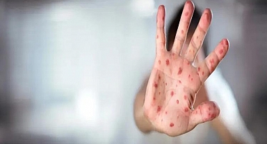 ABD'de kızamık alarmı: Vaka sayısı 624'e yükseldi