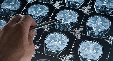 Alzheimer'da yeni umut: Erken evrede teşhisi mümkün kılacak kan testi ABD'de onaylandı